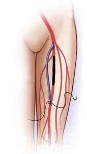 шунтирование артерии