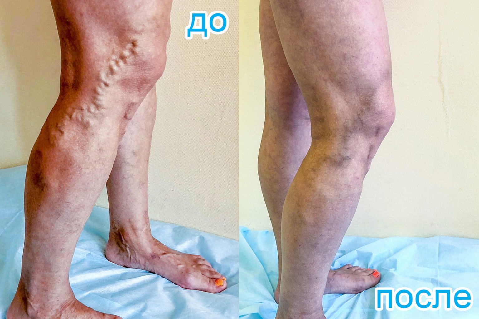 Малотравматичные методики лечения · Болезни вен · Сосудистый центр им ...