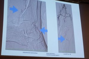16 октября, Научно-практическая конференция с мастер-классом «Баллон с лекарственным покрытием в лечении стено-окклюзионных поражений поверхностной бедренной артерии», Москва.