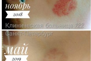 Мультифункциональная платформа CUTERA XEO и лазерная система CUTERA Excel V