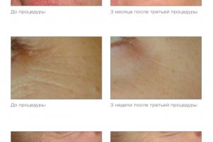 Мультифункциональная платформа CUTERA XEO и лазерная система CUTERA Excel V