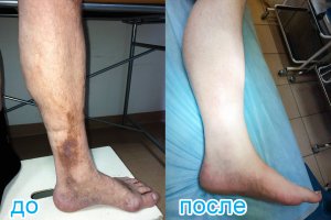 лечение перфорантных вен методом эндовенозной лазерной коагуляции