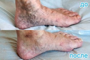 после применения транскутанного лазера и склеротерапии