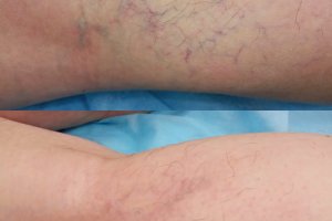 неэстетичные вены