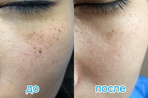 лечение пигментных пятен лазером Cutera