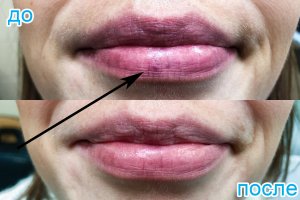 лечение неодимовым лазером гемангиомы нижней губы