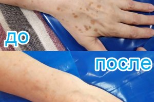 лечение пигментации