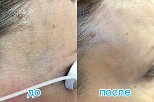 лечение неэстетичных вен височной области неодимовым лазером Cutera