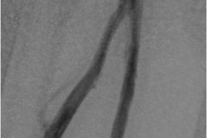 Лечение посттромбофлебитической болезни