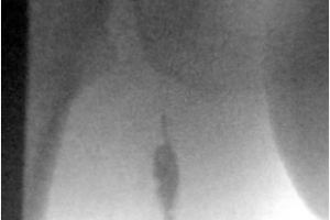 Лечение посттромбофлебитической болезни