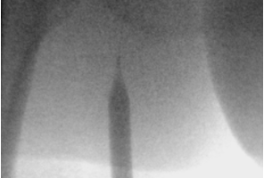 Лечение посттромбофлебитической болезни