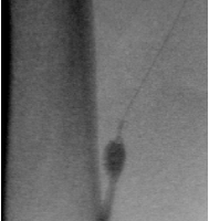 Лечение посттромбофлебитической болезни