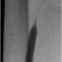 Лечение посттромбофлебитической болезни