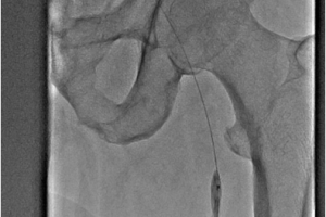 Лечение посттромбофлебитической болезни