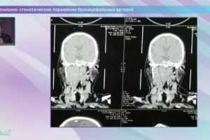 Окклюзионно-стенотические поражения брахицефальных артерий
