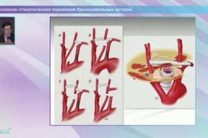 Окклюзионно-стенотические поражения брахицефальных артерий