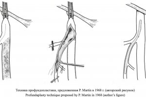 Новая публикация сосудистых хирургов Центра им. Т.Топпера в специальном выпуске журнала «Клиническая больница»