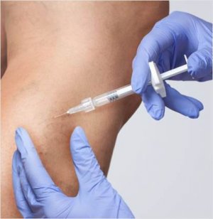 склеротерапия