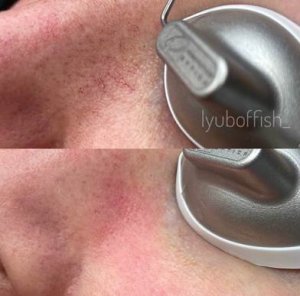 варикозные узелки