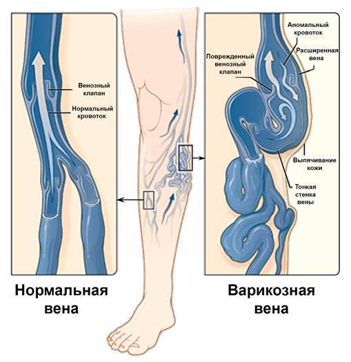 Болят вены на ногах ♻️ Как избавиться от боли при варикозе | Medcity