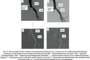 Новая публикация сосудистых хирургов Центра им. Т.Топпера в специальном выпуске журнала «Клиническая больница»